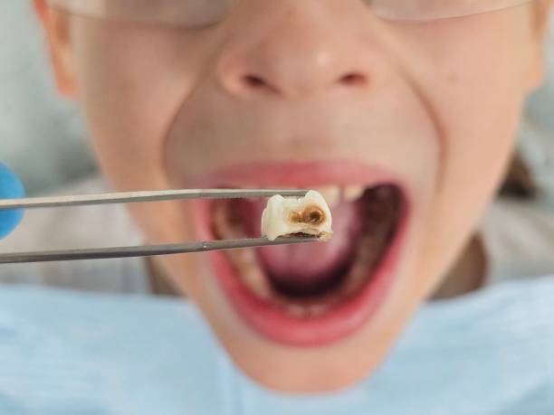 Best Urgent Tooth Repair  in Tidmore Bend, AL